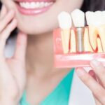 implant dentist in Walnut Creek