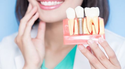 implant dentist in Walnut Creek