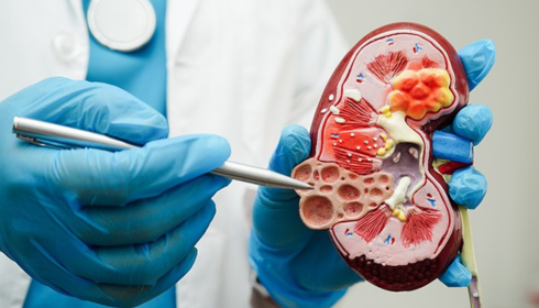 Kidney Stone Treatment