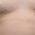 Gynaecomastia in bangalore