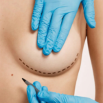 breast treatment in India