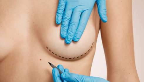 breast treatment in India