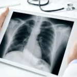 computed radiography