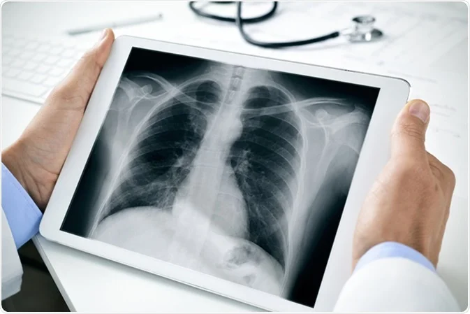computed radiography